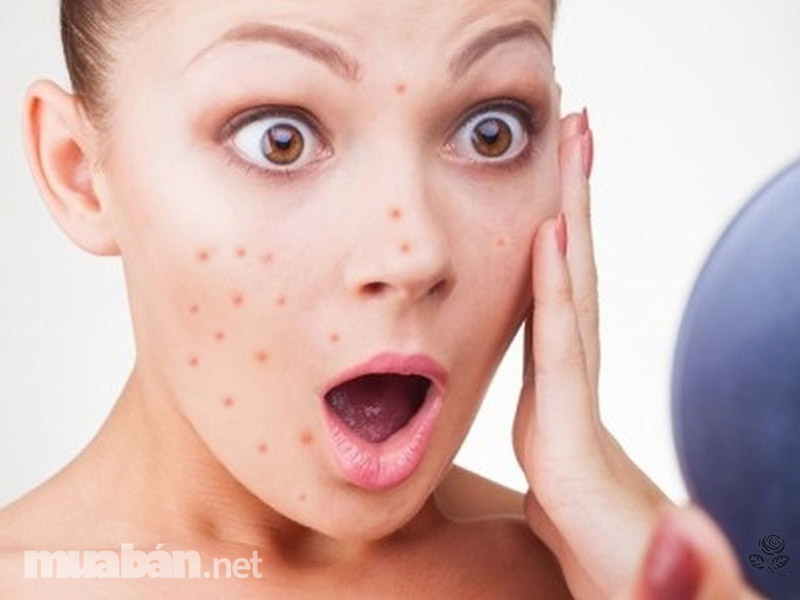 Mách Bạn 5 Cách Trị Mụn Đầu Đen, Mụn Bọc Hiệu Quả Tại Nhà 6 Nguyên Nhân Khiến Mụn Dai Dẳng Không Dứt