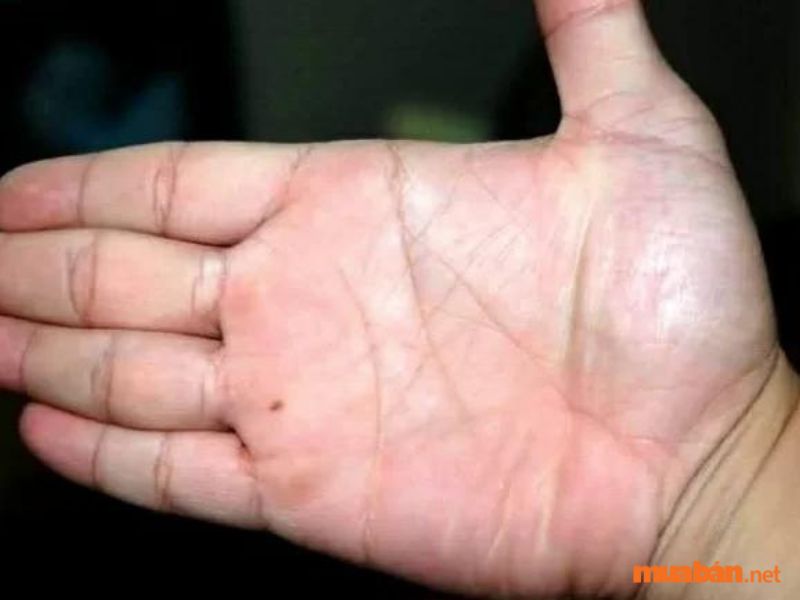 Nốt ruồi trong lòng bàn tay, nằm dưới ngón áp út (gò thủy tinh)
