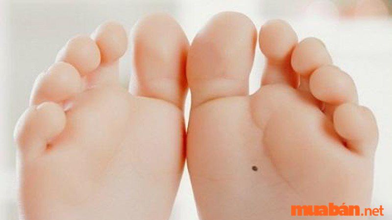 Nốt ruồi ở lòng bàn chân