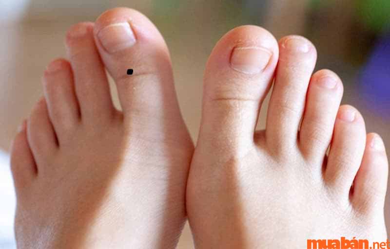 nốt con ruồi ở ngón chân cái