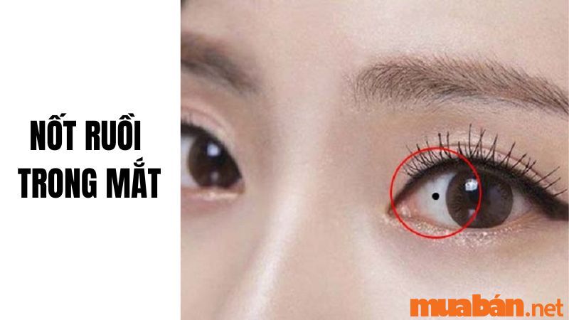 Mụn ruồi trong mắt : Nguyên nhân, triệu chứng và cách điều trị hiệu quả