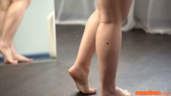 nốt ruồi ở bắp chân