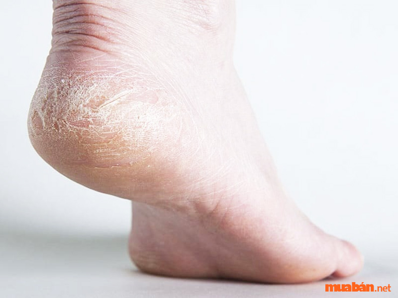 Người có gót chân nứt nẻ thường sẽ có tình trường bấp bênh