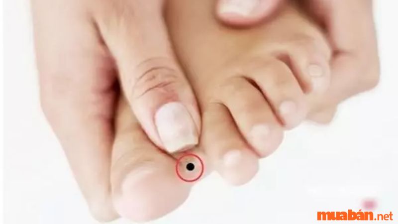 Nốt ruồi tại khe giữa ngón cái và ngón chân trỏ