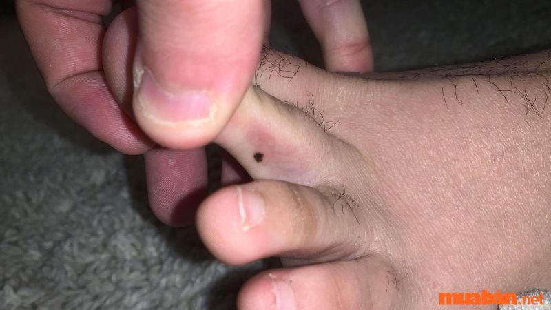 Nốt loài ruồi xuất hiện tại ở ngón chân loại 2