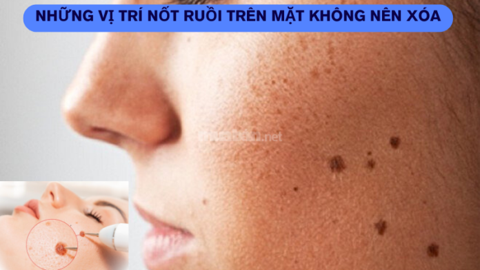 những vị trí nốt ruồi trên mặt không nên xóa